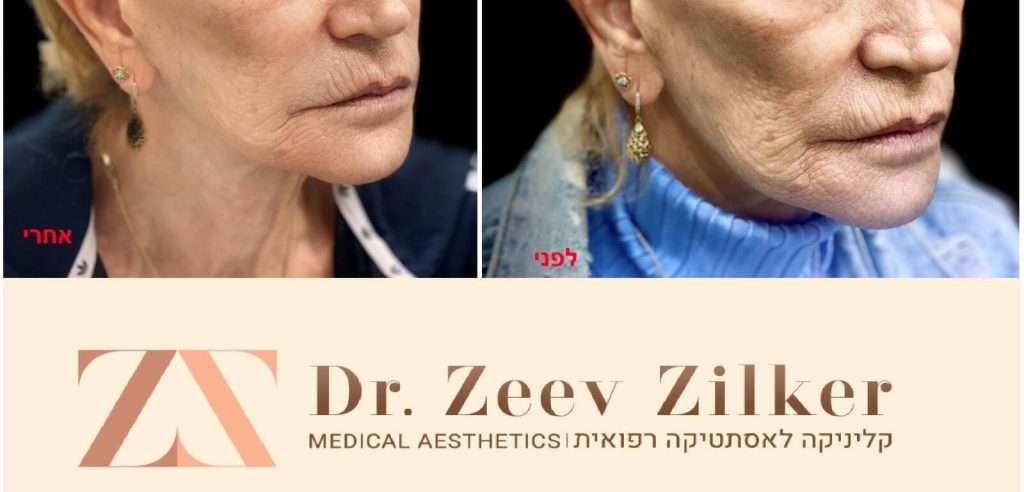 עיצוב קו לסת - בהזרקה (ללא ניתוח) | ד
